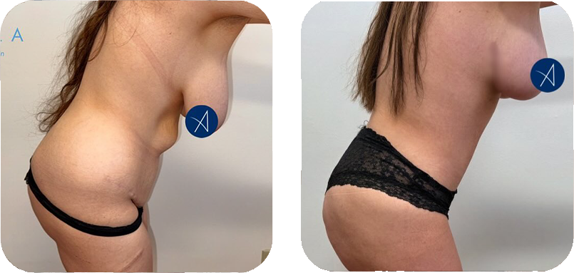 before-after-2