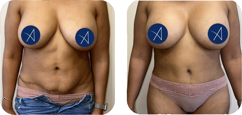 before-after-3