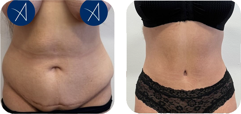 before-after