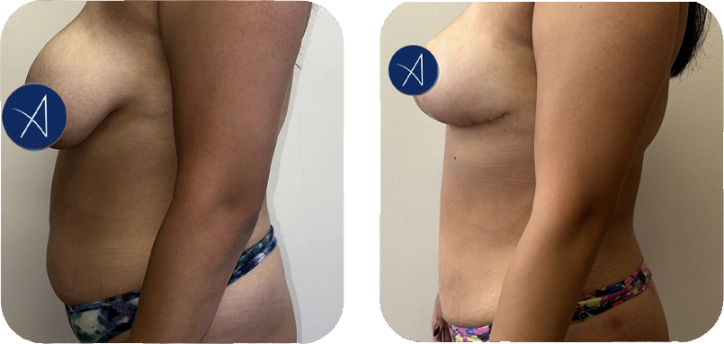 before-after-5