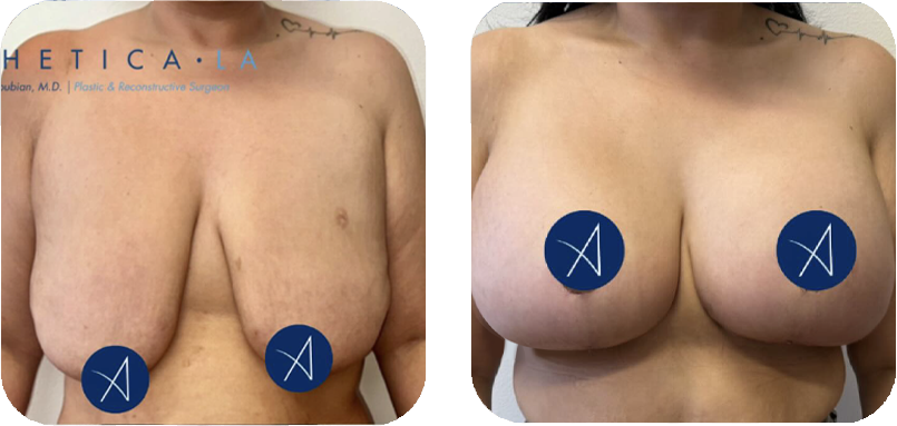 breast-lift-before-after
