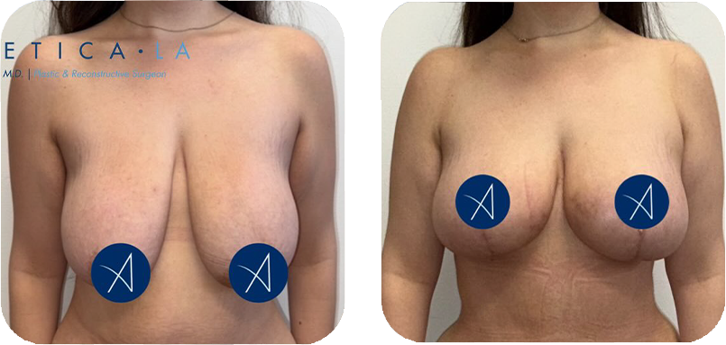 breast-lift-before-after-2