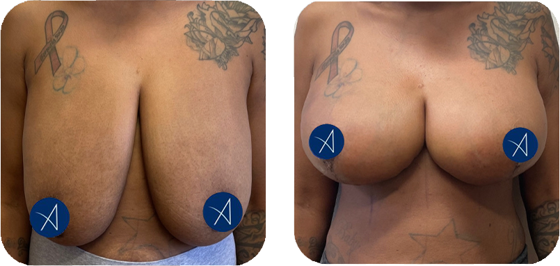 breast-lift-before-after-3