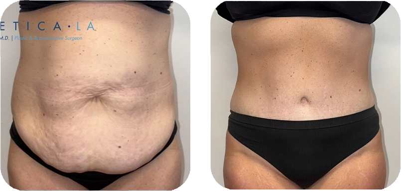 tummy-tuck-before-after-1