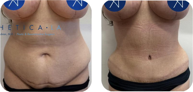 tummy-tuck-before-after-2